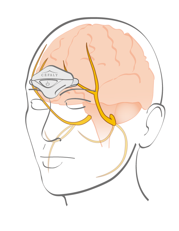 Cefaly CEFALY® Electrodes | Official Replacement Accessories for Migraine ...